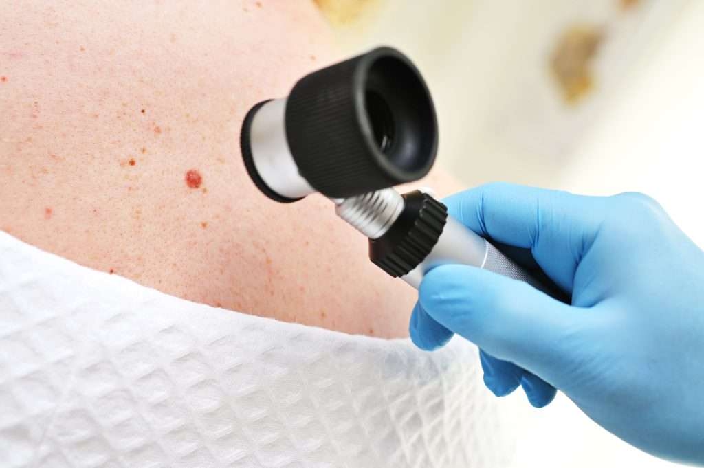 Doctor examining a possible cyst to prepare for cyst removal.